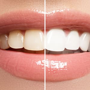 輝く白い歯のホワイトニング